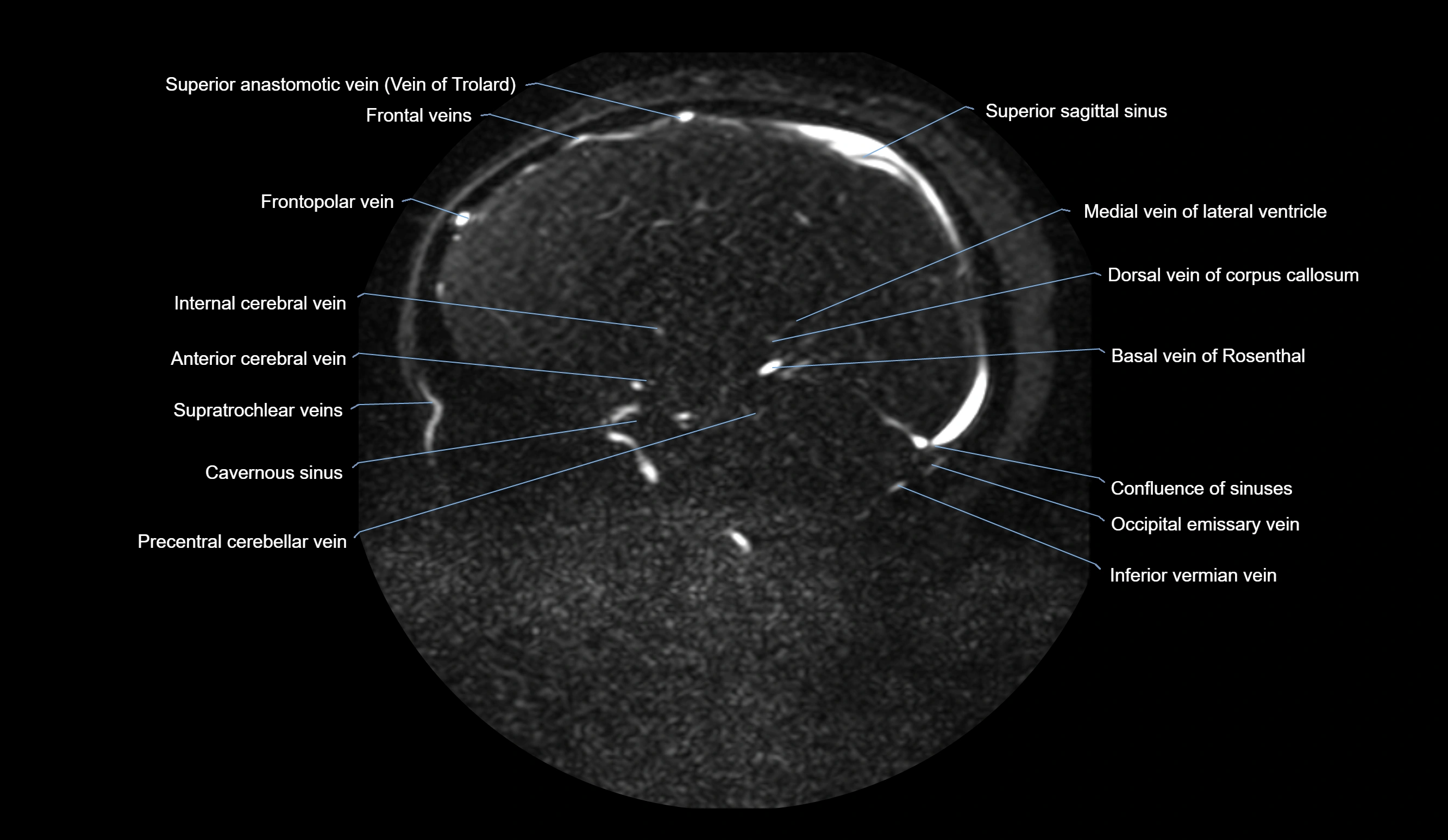 MRV brain sagittal anatomy 3T MRI labelledimages -00047.webp